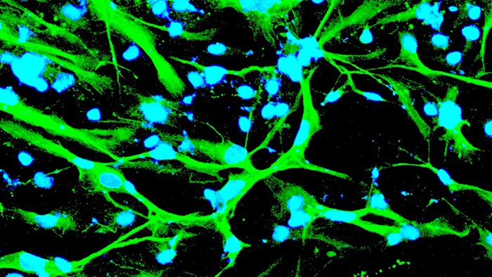 Stem cells help untangle Alzheimer’s, other disease origins